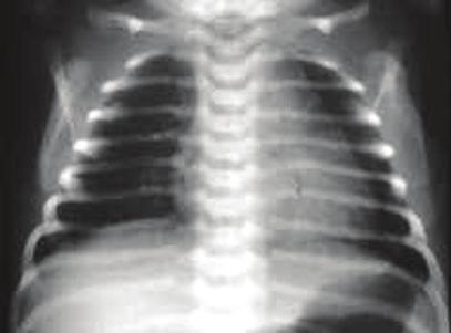 parênquima pulmonar de forma aguda. A doença desse tipo que mais característicamente ocorre em crianças recém nascidas é a membrana hialina.