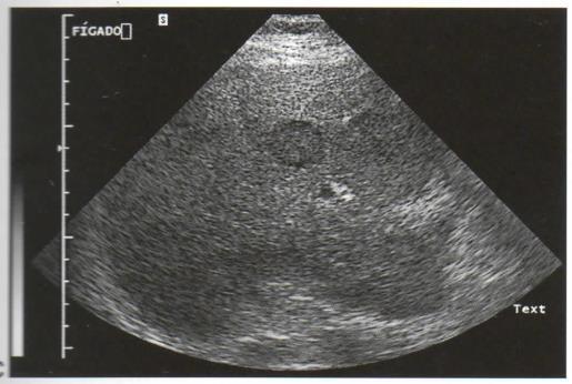 Ultrassom transabdominal Baixa sensibilidade (50-77%) / (20%, <1 cm) Aplicação restrita Método operador-dependente Achado típico: Lesão hipo ou isoecogênica delimitada por halo hiperecogênico ( lesão