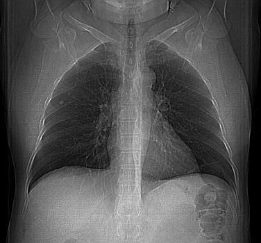 TC: terminologia Tons de cinza: Hipodenso / Isodenso / Hiperdenso 46 Escala de Cinza - Densidades TECIDO Pulmão Gordura