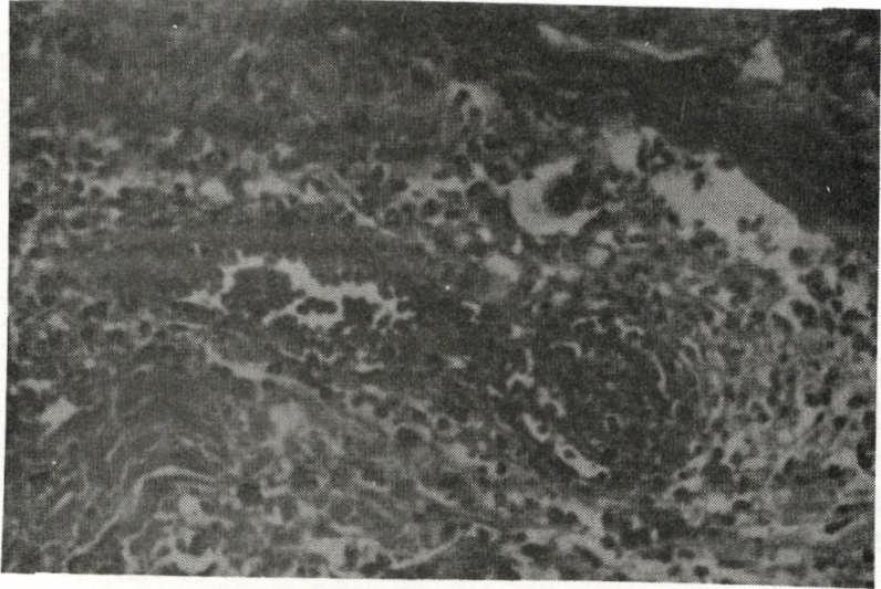 epitelióides. H.E. 100 X. FIGURA 5 - Biópsia de pele. Fenômeno de Lúcio. Detalhe evidenciando pequeno vaso no interior de infiltrado virchoviano.