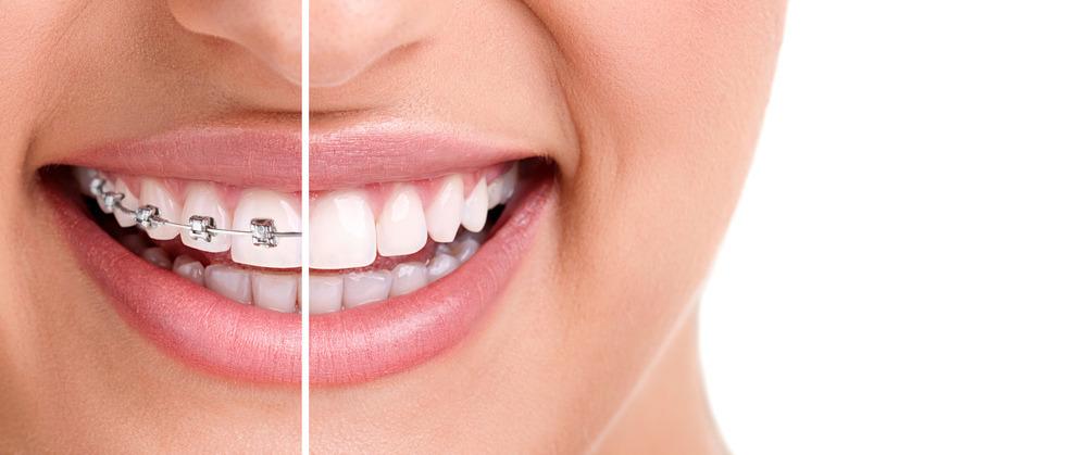 Ortodontia Autologáveis: Tecnologia e menos tempo de tratamento... O Q U E É O R T O D O N T I A?
