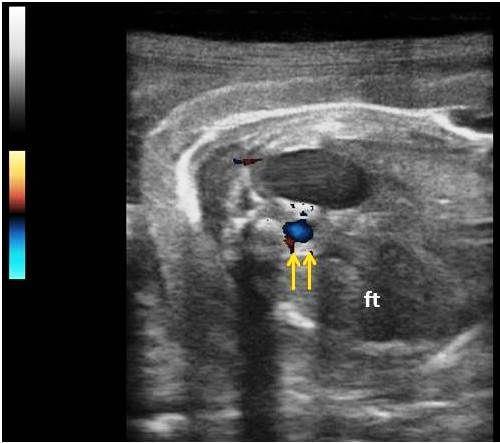 Figura 3 - Imagem ultrassonográfica de feto canino (ft) com aproximadamente 51 dias de gestação. Note a aorta fetal (setas) na avaliação ultrassonográfica modo Doppler em cores.