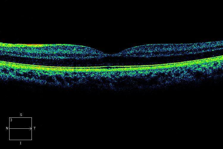 Baptista, AMG; Macedo, AF (2012). Ophthalmology (under review) Shamir Academy, 14.