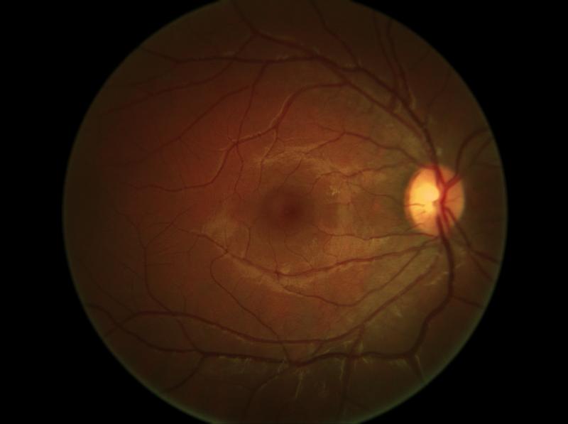 Imagiologia Ocular D: Luminância } Após o alinhamento coma a iluminação de IV a fotografia é obtida com uma