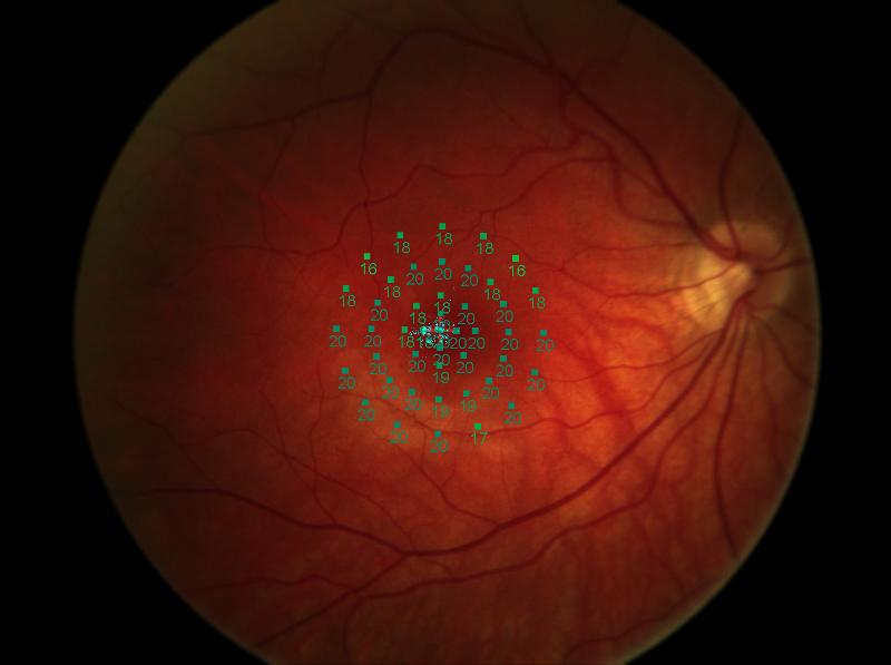 reflectância da retina varia muito entre pessoas devido à pigmentação do fundo e transparência dos meios
