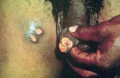 Cancro Mole Úlcera em prepúcio e úlcera em face interna de coxa: observar que as lesões do Cancro Mole,