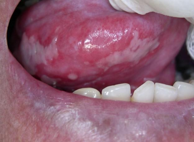 FONOAUDIOLOGIA x CUIDADO PALIATIVO Na fase avançada, 60% dos pacientes com câncer apresentam alterações orais como xerostomia (boca seca); redução da higiene oral; estomatites; candidíase; mucosites;