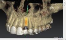 planeje implantes em 3D com base na anatomia dos pacientes e