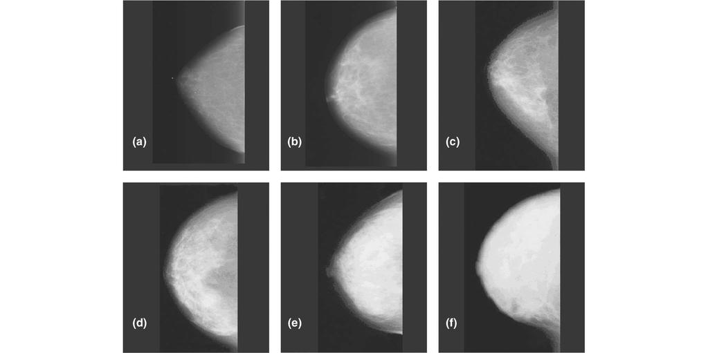 19 Figura 1 - Imagens mamográficas com diferentes densidades.