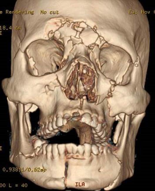 Pode-se citar o acesso bicoronal, paranasal, supraorbital, subtarsal, subciliar, transconjuntival, vestibulomaxilar, vestibulomandibular, pré-auricular, retromandibular, submandibular e cervical (11).