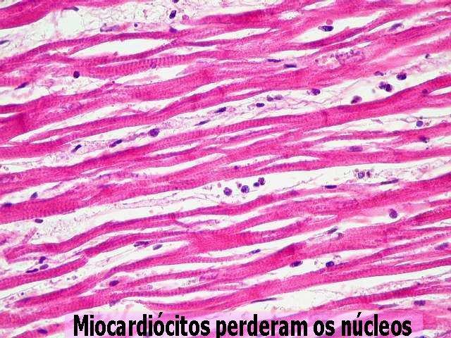 Edema: aumento do líquido nos espaços