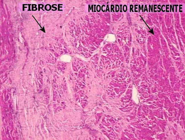 Fibrose do miocárdio pós-infarto Microscopicamente o infarto se caracteriza por necrose de coagulação (exceto no cérebro onde ocorre necrose de liquefação).