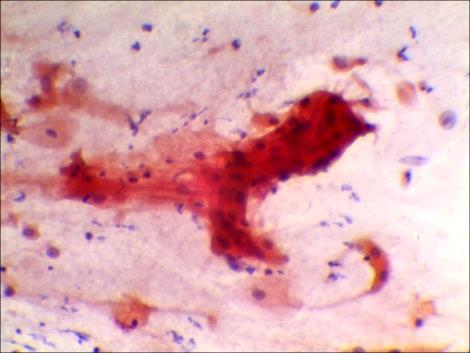 possuírem pelo menos 2 exames citopatológicos, após o tratamento radioterápico.