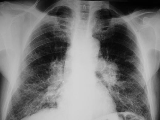 associada a estruturas tubulares dirigindo-se para o hilo. Malformação arteriovenosa pulmonar.