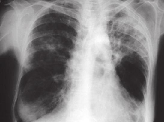 564 Campos LEM, Pereira LFF A PEC é uma doença grave de início insidioso, com sintomas respiratórios e sistêmicos inespecíficos, mas com um quadro radiológico bem sugestivo de consolidação periférica