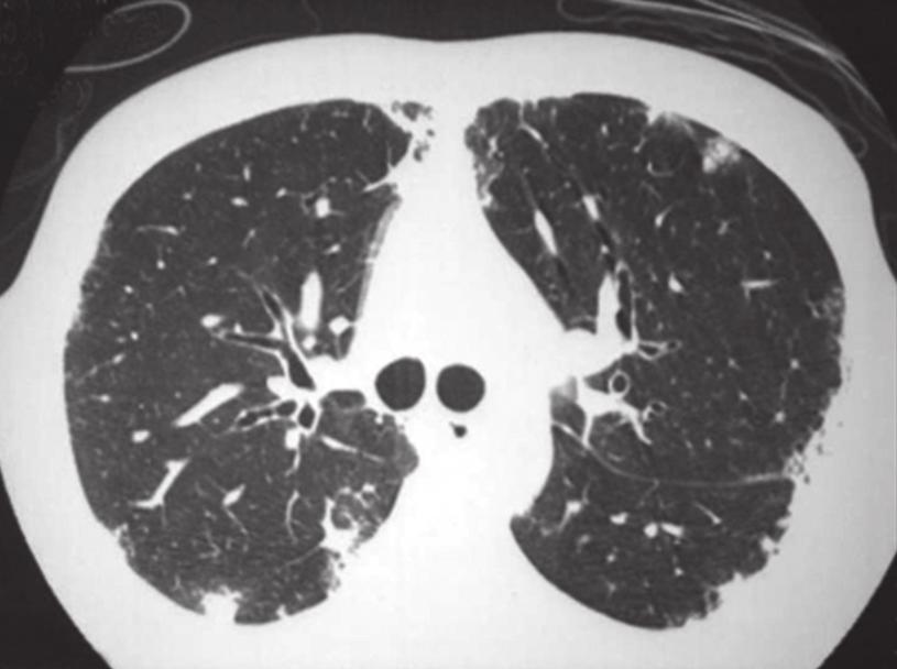 Eosinofilia pulmonar 565 festações sistêmicas, como febre (77,4%), astenia (88,3%) e perda de peso (75%) foram os sintomas mais frequentes.