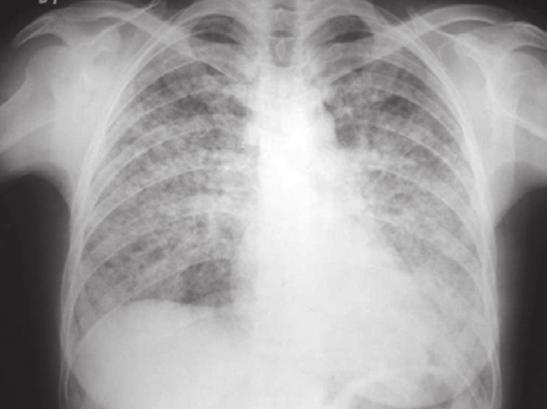 566 Campos LEM, Pereira LFF A PEA é caracterizada por uma insuficiência respiratória aguda, febre, infiltrado pulmonar difuso e eosinofilia intensa demonstrada no LBA e/ou no tecido pulmonar.