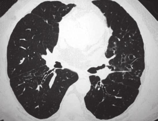 Eosinofilia pulmonar 567 sível sem deixar sequelas. (29,30) A PEA pode ser causada por drogas, parasitas, fungos, inalação de produtos tóxicos ou pode ser idiopática (Figura 3).