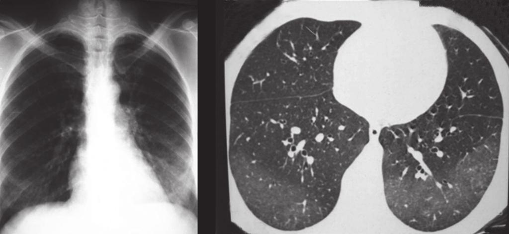 Eosinofilia pulmonar 569 mucoide de alta atenuação é definida quando a densidade do muco for maior que a do músculo esquelético.