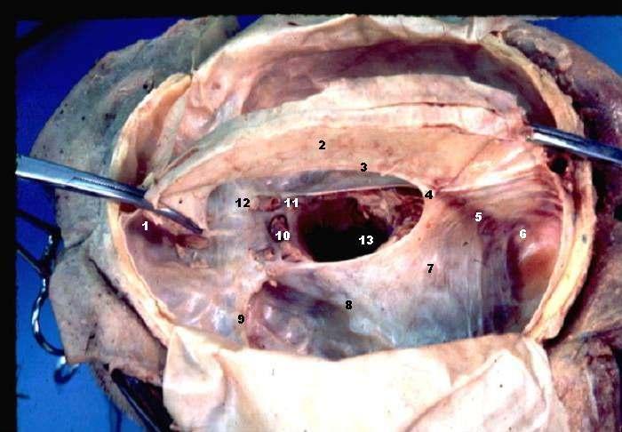 1. Crista galli 2. Falx cerebri 3. Sinus sagittalis inferior 4. Incisura tentorii - Tentorial incisure 5. Sinus rectus 6. Confluens sinuum 7.