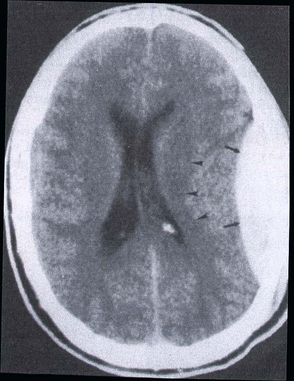 Epidural hematoma. Usually s/p head trauma. Brief +LOC, followed by lucid period. Then drowsy/coma/death.