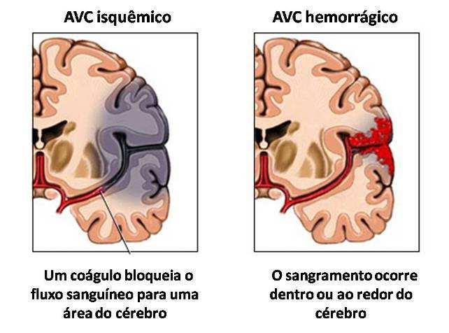 Neurônio aferente Receptor intramuscular (sensorial) Músculo Placa motora