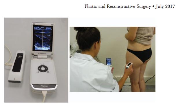 Ultrassom com BodyMetrix Medição da espessura da gordura subcutânea com ultra-som.