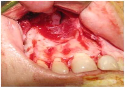 (Figura 3). Figura 5: Cavidade patológica após enucleação. Notar depressão da maxila visualizada na TC. 2.