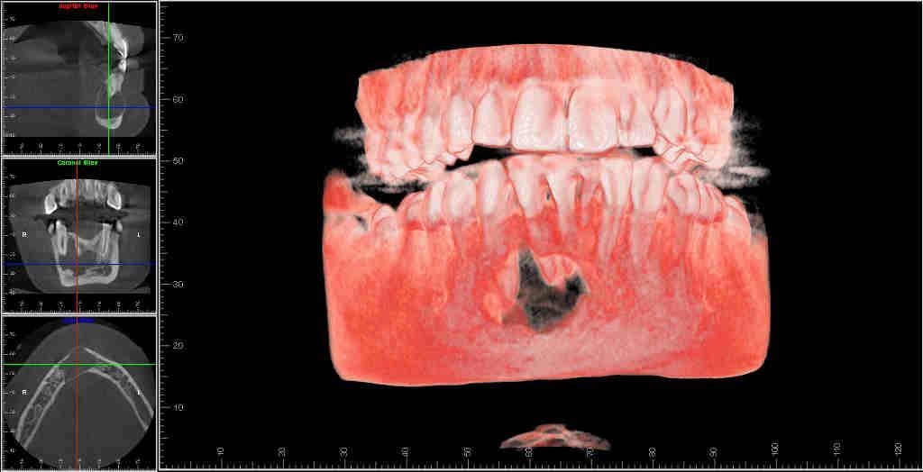 22 Figura 5 Imagem em 3D, com a presença dos três cortes tomográficos na lateral da imagem Fonte: Cedidas gentilmente pela Dra.
