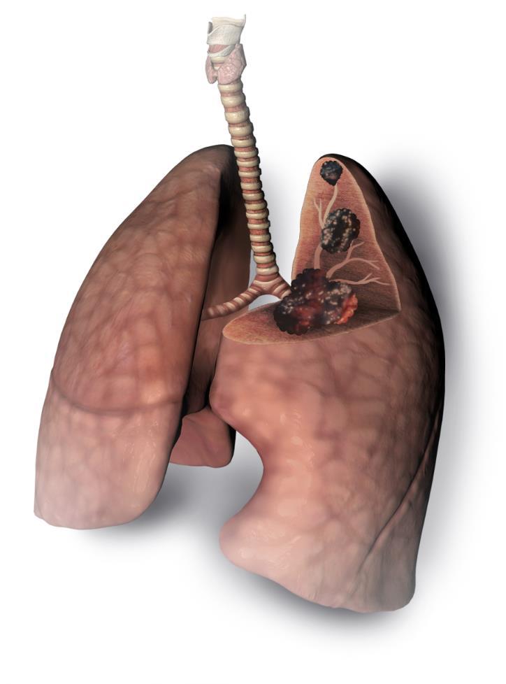 Cancro O cancro do pulmão é o cancro mais comum em todo o mundo, com mais de um milhão de