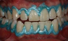 profissionais de saúde bucal A Angelus, como sempre, tem ideias inovadoras e acaba de desenvolver um excelente material para o clareamento dental.