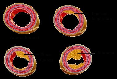 Fisiopatologia obstrução da luz das artérias coronárias por aterosclerose, caracterizada por depósito de placa de gordura no endotélio das coronárias, associado
