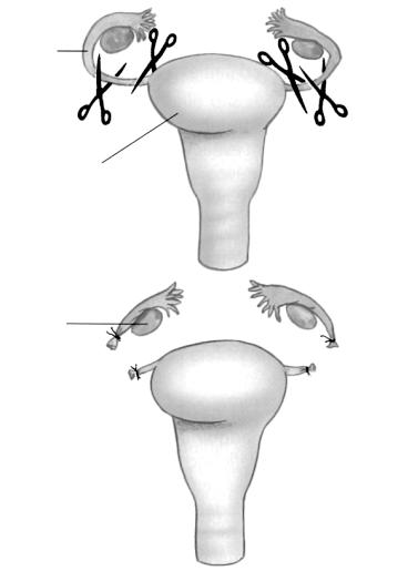 Questão 34 As figuras abaixo mostram procedimentos cirúrgicos no aparelho reprodutor masculino e feminino denominados de vasectomia (Figura ) e ligação tubária (Figura 2).