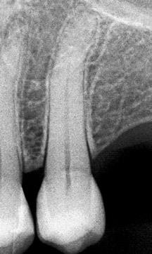 Consolaro, A. Figura 1 - Trauma oclusal caracterizado pelo espessamento da cortical óssea alveolar (setas) e do espaço periodontal.