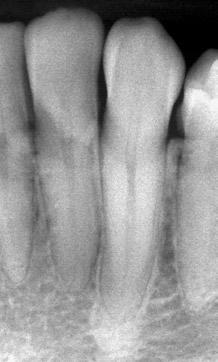 óssea () da maior parte da crista óssea interdentária e com espessamento da cortical óssea alveolar e do espaço periodontal em ambos os dentes (setas).