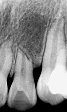 Na distal do canino inferior, observa-se a reabsorção óssea na crista interdentária em forma de V (círculo) e espessamento da cortical óssea alveolar e do espaço periodontal (setas).