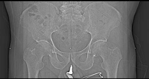 Superior: borda inferior de L3 Inferior: 5,0 cm abaixo do marcador anal g) Marcação do paciente: - A realização da tatuagem definitiva para marcação do isocentro pode ser realizada no momento da