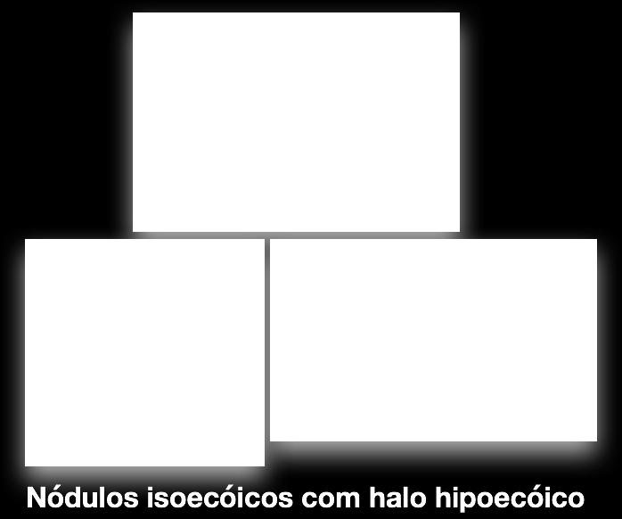 Nódulos ISOECOICOS mesma cor que o tecido