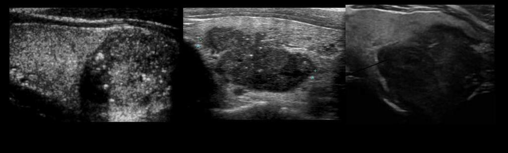 Maligno Bethesda V ou VI O carcinoma papilífero da tireóide representa 95% dos tipo de câncer de tireóide. A punção consegue diagnosticar com boa acurácia esse tipo de lesão.