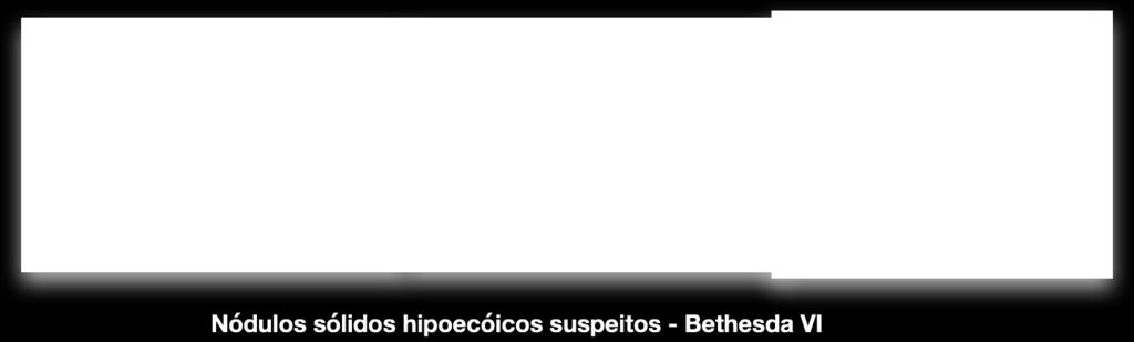 Bethesda V Suspeito de maligno O patologista que analisou o material coletado suspeitou de câncer mas não viu características suficientes para fechar o diagnóstico.