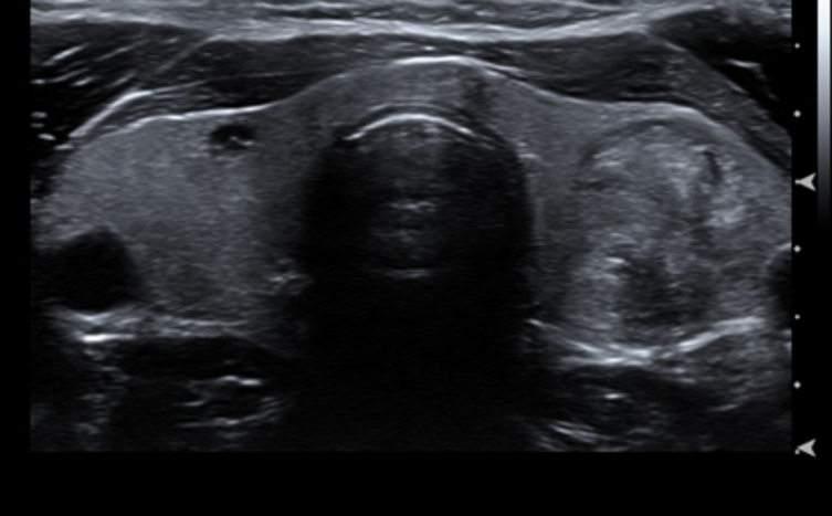 Provavelmente você descobriu seu nódulo através do ultrassom da tireóide. Atualmente 95% dos nódulos na tireóide são descobertos durante um exame de ultrassom.
