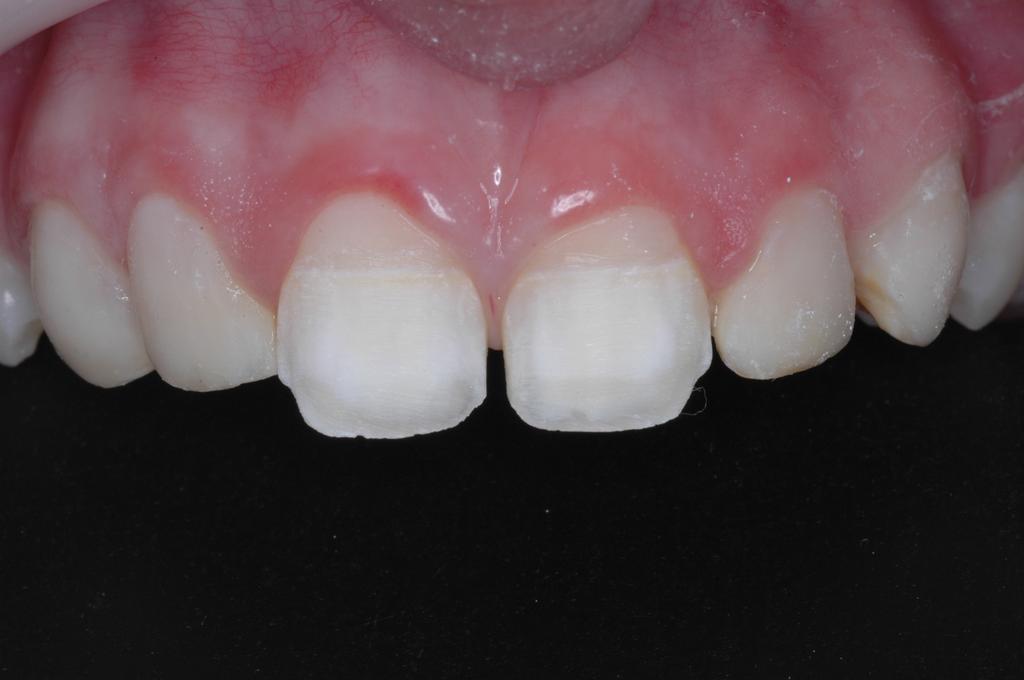 fabricante (Figura 4). Após o clareamento, o dessensibilizante Dessensibilize KF 0,2% foi reaplicado nos dentes anteriores superiores por 10 minutos.