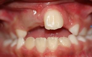10 RELATO DE CASO A paciente L.M.C., gênero feminino, melanoderma, com sete anos de idade, apresentou-se para exame odontológico.