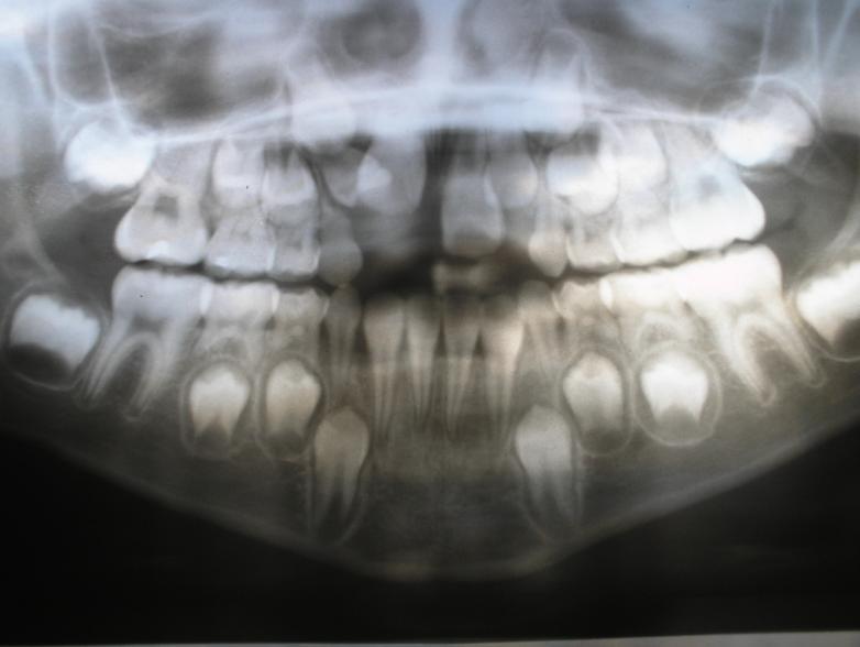 A demora na erupção do dente sucessor motivou a consulta. No exame clínico, constatou-se a ausência do 11.
