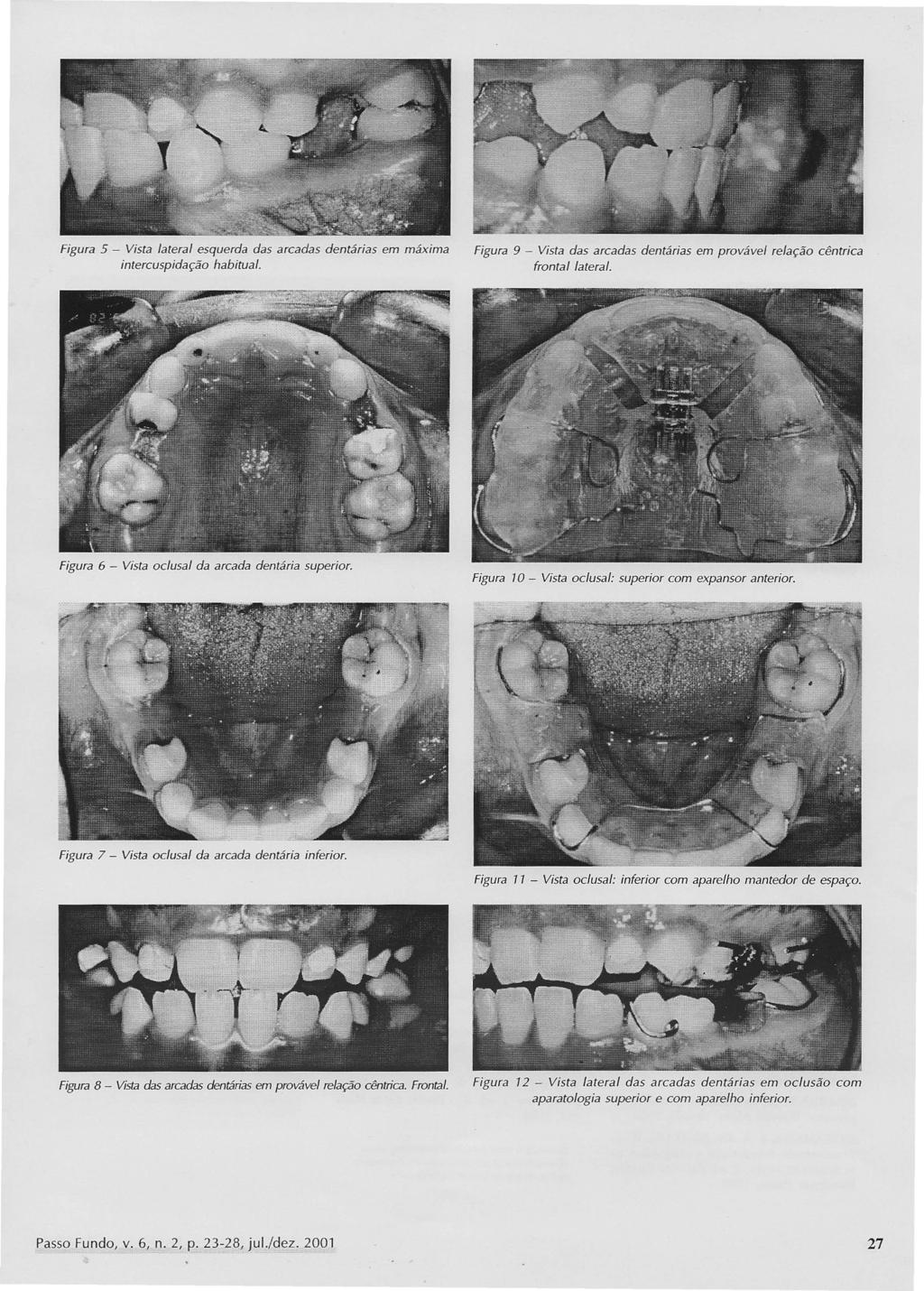 Figura 5 - Vista lateral esquerda das arcadas dentárias em máxima intercuspidação habitual. Figura 9 - Vista das arcadas dentárias em provável relação cêntrica frontal lateral.
