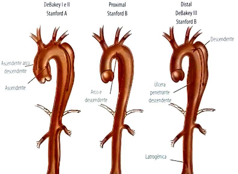 Figura 1 - Figura 2 Classificação da doença da aorta: sistema de DeBackey e Stanford. A DAA também é classificada quanto ao tempo de ocorrência.