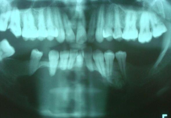 Exame físico Presença de aumento de volume em região anterior de mandíbula, entre os dentes 33 e 45, causando expansão da cortical óssea vestibular, sem alteração da cor da mucosa adjacente (Fig. 1).