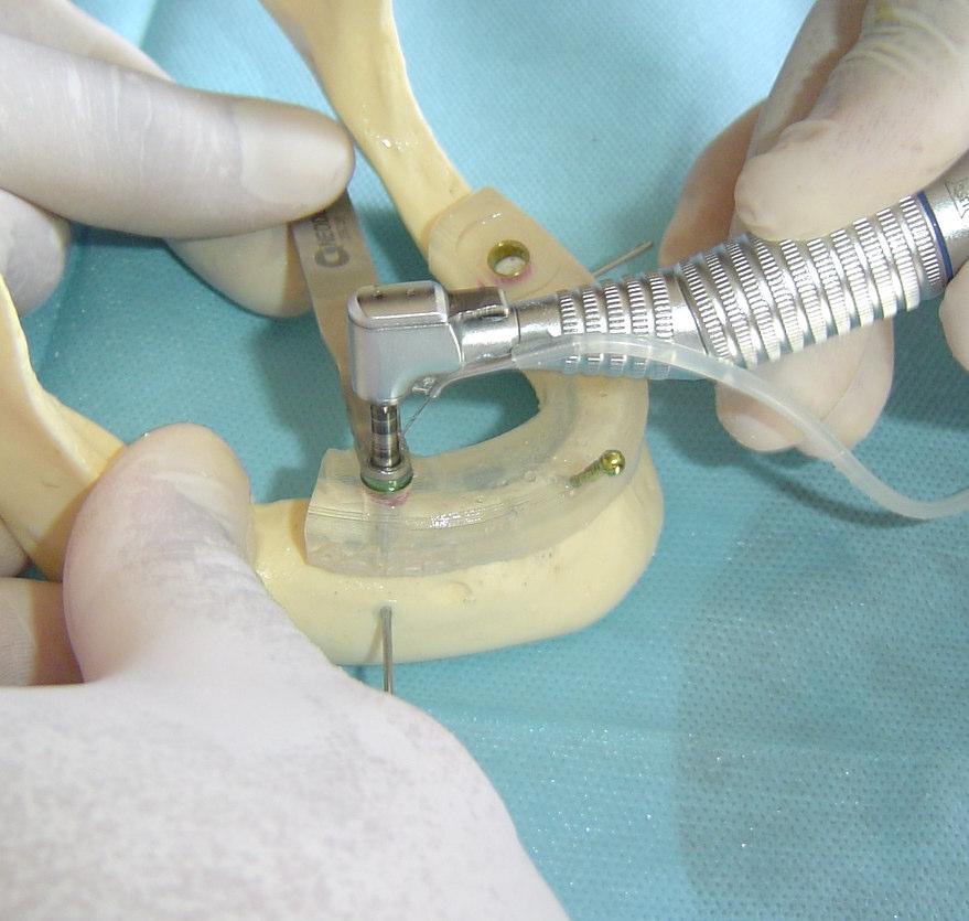 c) Colocação do guia-implante O guia-implante é uma anilha que limita os movimentos laterais do montador no momento da colocação do implante.