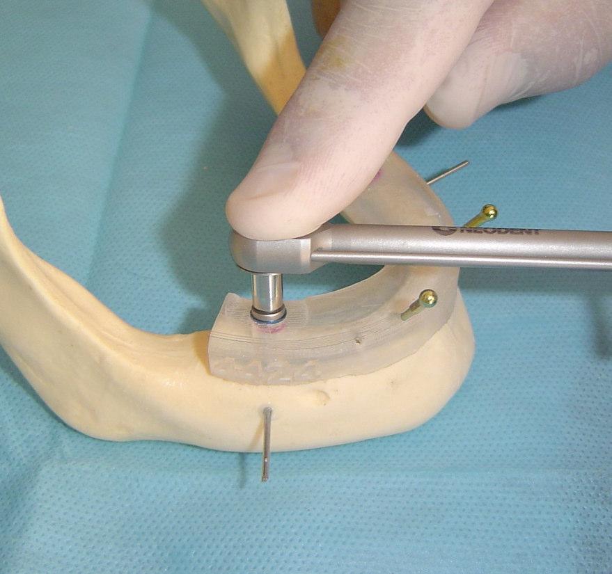 De acordo com o sistema utilizado, o implante deve ser introduzido no seu leito até o