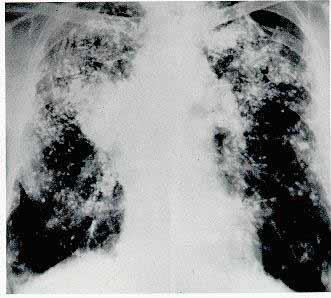 Respiratória - Silicose: Riscos de Contrair Doenças Diagnostica-se com uma